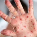 Дорослі будь-якого віку відтепер можуть безоплатно вакцинуватися від кору, паротиту та краснухи